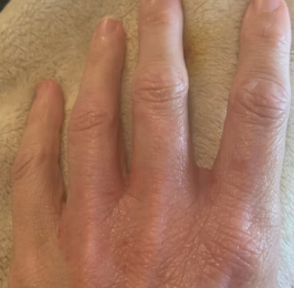 After result close-up of a hand with visible skin texture on a textured surface