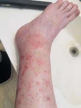 Foot with visible redness and lesions on a white surface