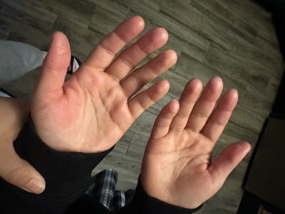 Adult hand showing after result of using the touchy skin salve.