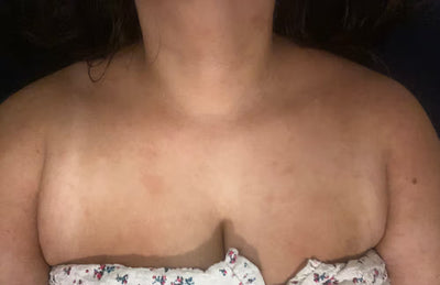 After result a partial view of a person wearing a strapless top with heal skin.