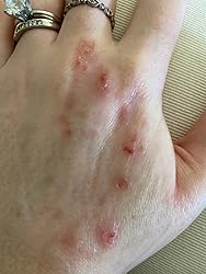 Close-up of a hand with visible skin conditions that is almost heal on a beige background