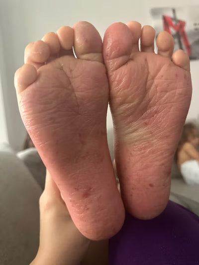 After result, a close-up of two feet with visible skin improvement on a blurred background.