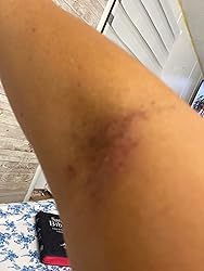Close-up of a person's arm with a visible scar on a wooden floor background