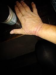 Hand holding a bottle cap on a dark surface with improve skin texture.