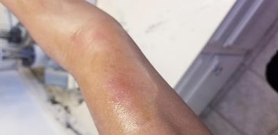 Close-up of a person's arm with a visible almost heal bruise.
