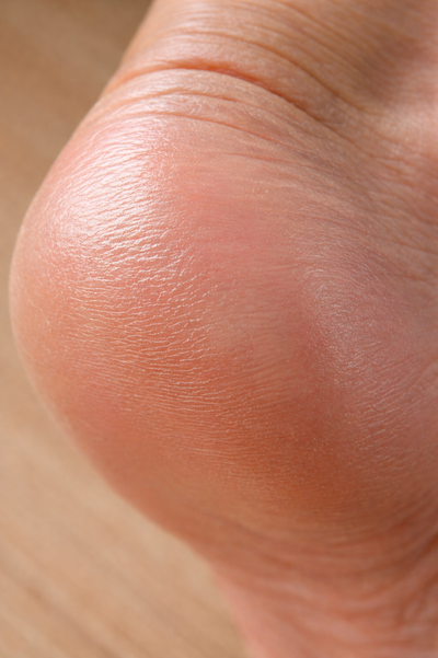 Close-up of a foot with moisturize heel