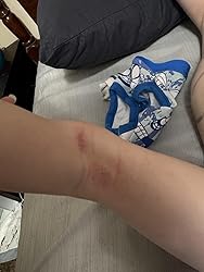 Close-up of a child's arm with a small cut, wearing a blue and white patterned garment.