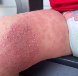 Red and irritated skin on a baby leg