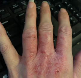 Hand with visible skin condition against a keyboard background
