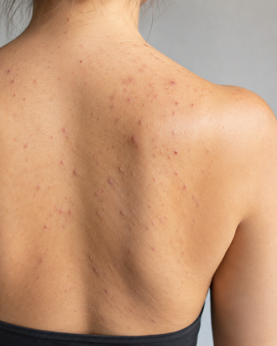 Back of a person with visible skin texture and small blemishes on a neutral background