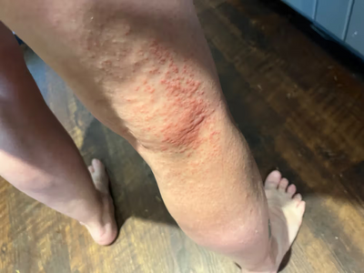 Redness and irritation on a person's leg on a wooden floor