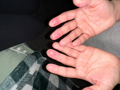 Adult close-up of two hands, before using touchy skin salve.
