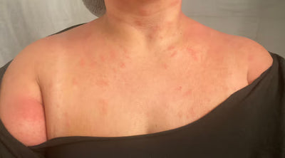 Close-up of a person's shoulder and neck with visible skin conditions.