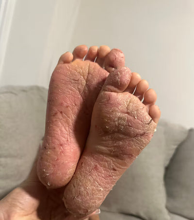 Close-up of a foot with visible skin texture and conditions on a neutral background