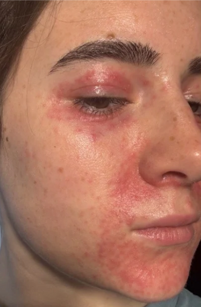 Close-up of a person's face with redness around the eye area
