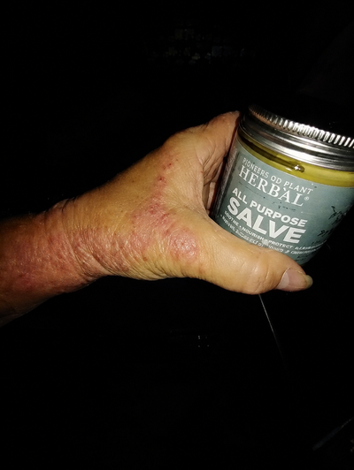 Hand holding  a jar of all purpose herbal salve with  visible skin issue against a dark background.