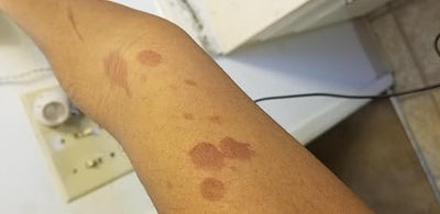 Person's arm with visible skin conditions on a neutral background