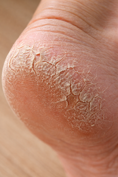 Close-up of a foot with dry, cracked skin on the sole.