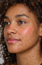 Close-up of a person with redness and acne rashes on her face