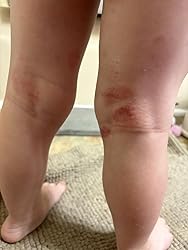 Close-up of a child's legs with visible skin irritation on a textured surface.