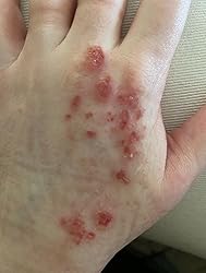 Close up image of a hand with redness and eczema