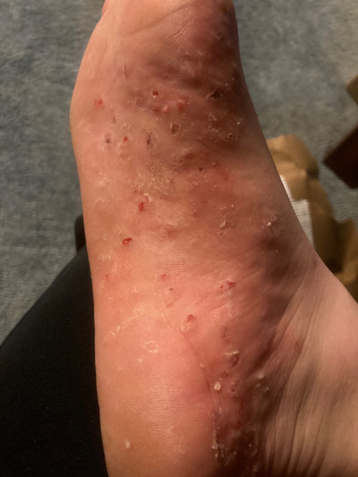 Close-up of a foot with small red bumps on a gray surface