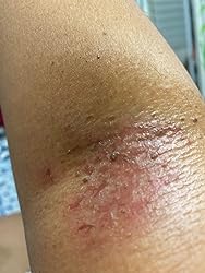 Close-up of a skin condition on a person's arm
