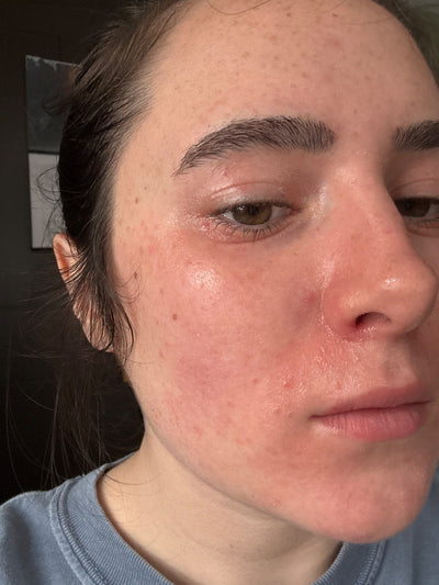 Close up image with improved skin face of a women after using Touchy Skin Salve.