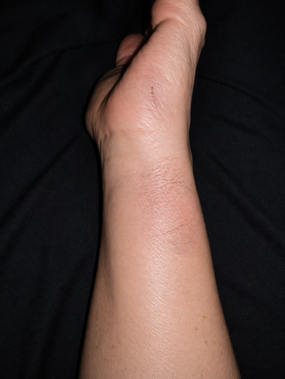 Close-up of a person's leg with a visible scar against a dark background