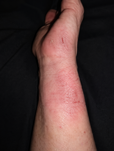 Close-up of a person's wrist with visible skin irritation on a dark background