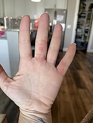 Hand with almost healed skin indoors with a blurred background