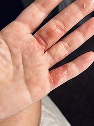 Hand with visible skin irritation or rash