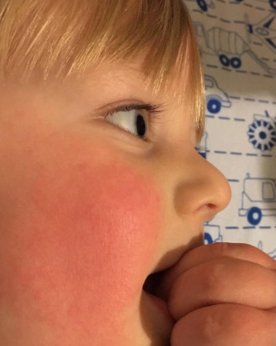 Close-up of a child with a red face, possibly sunburned, against a patterned background.